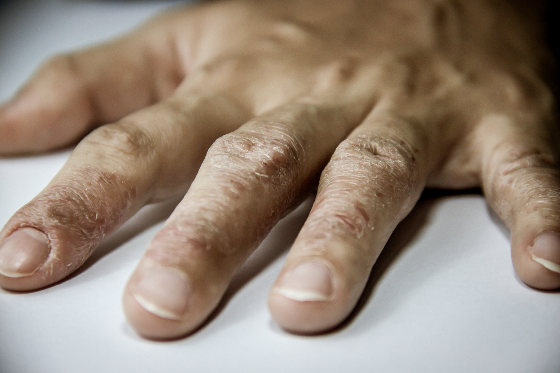 手足藓#手足藓(tinea manuum pedum)是一种由真菌感染引起的皮肤病