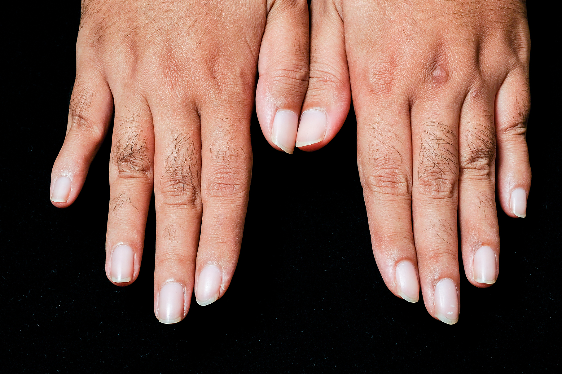 手部皱纹多如何去除?