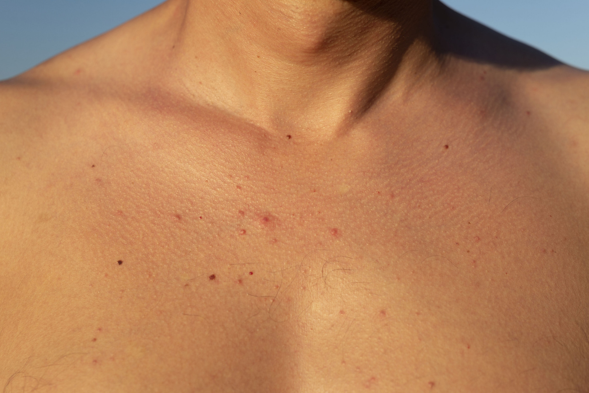 胸前背后长痘痘是怎么回事  胸前和背后出现痘痘的情况可能与多种因素
