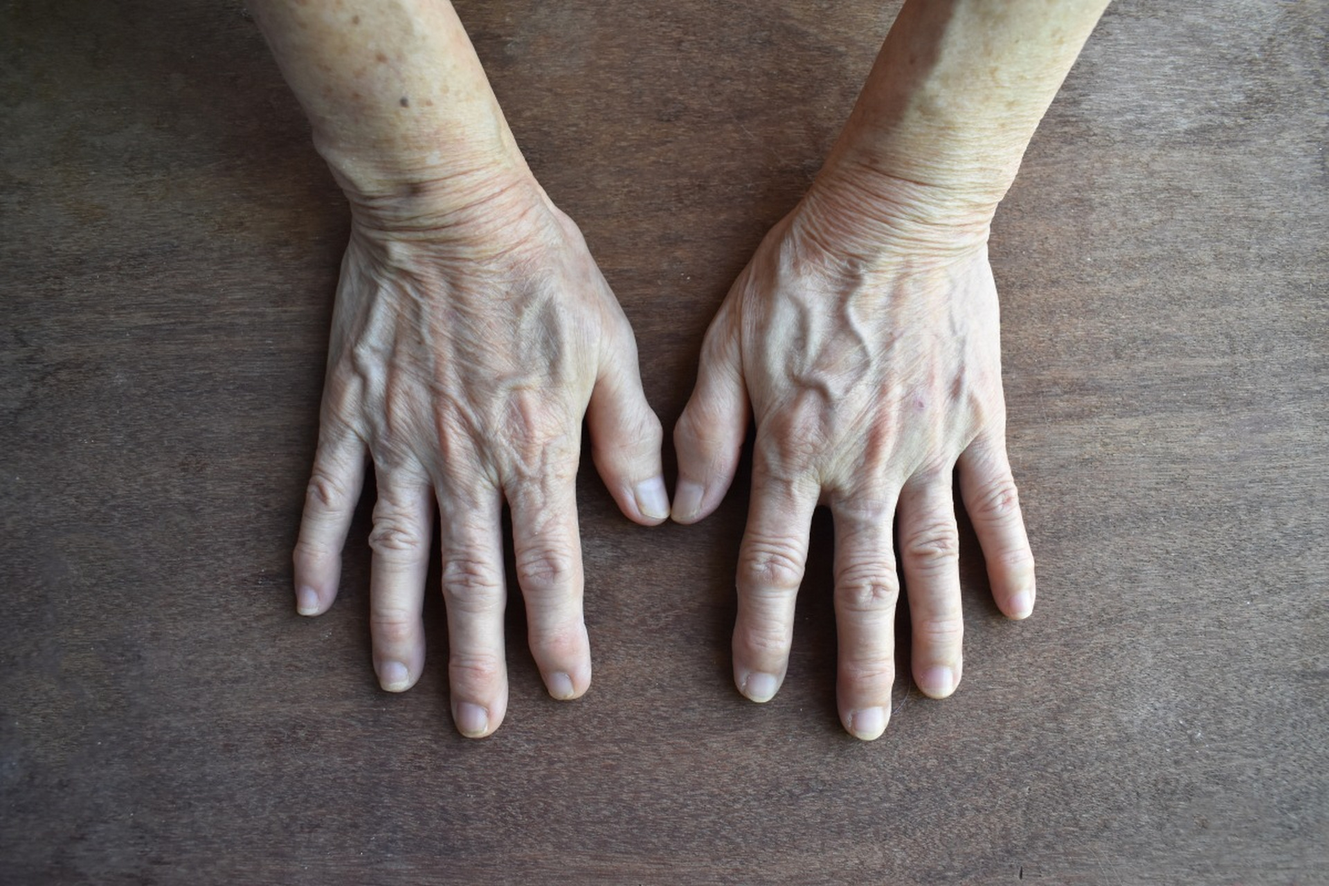 类风湿 关节肿痛晨僵 怎么办 你是不是关节呈游走性疼痛,早起活动受限