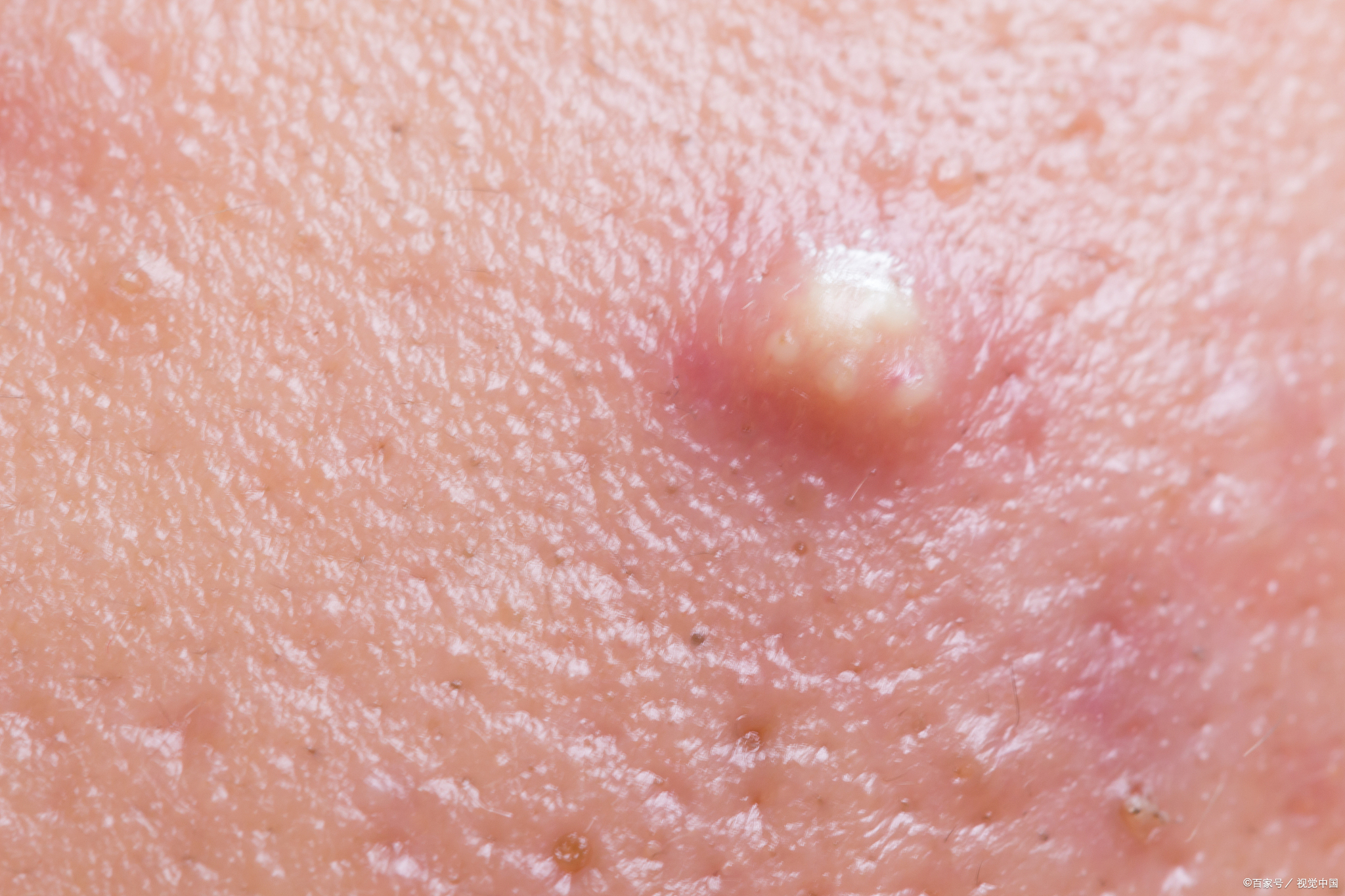 男人下面长痘痘怎么回事?