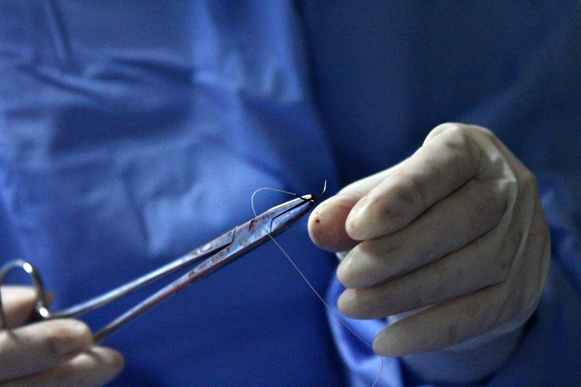 双环法缩胸手术的切口设计通常是在乳房下缘,胸大肌表面和乳头乳晕