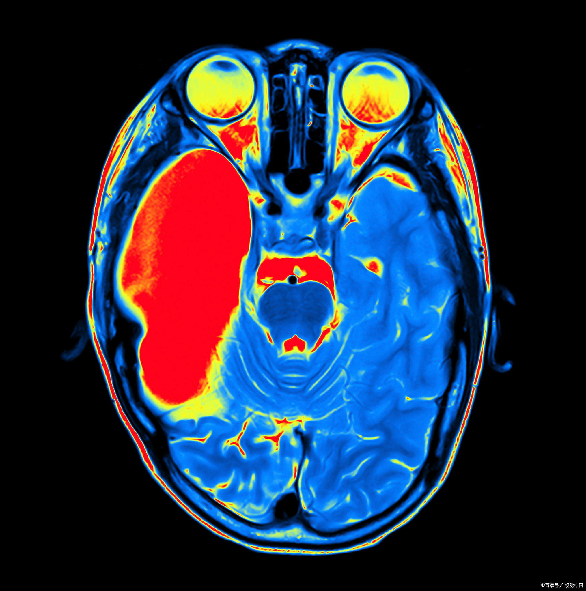 在进行脑部ct检查时发现脑部高密度影.有患者怀疑是不是得脑肿瘤