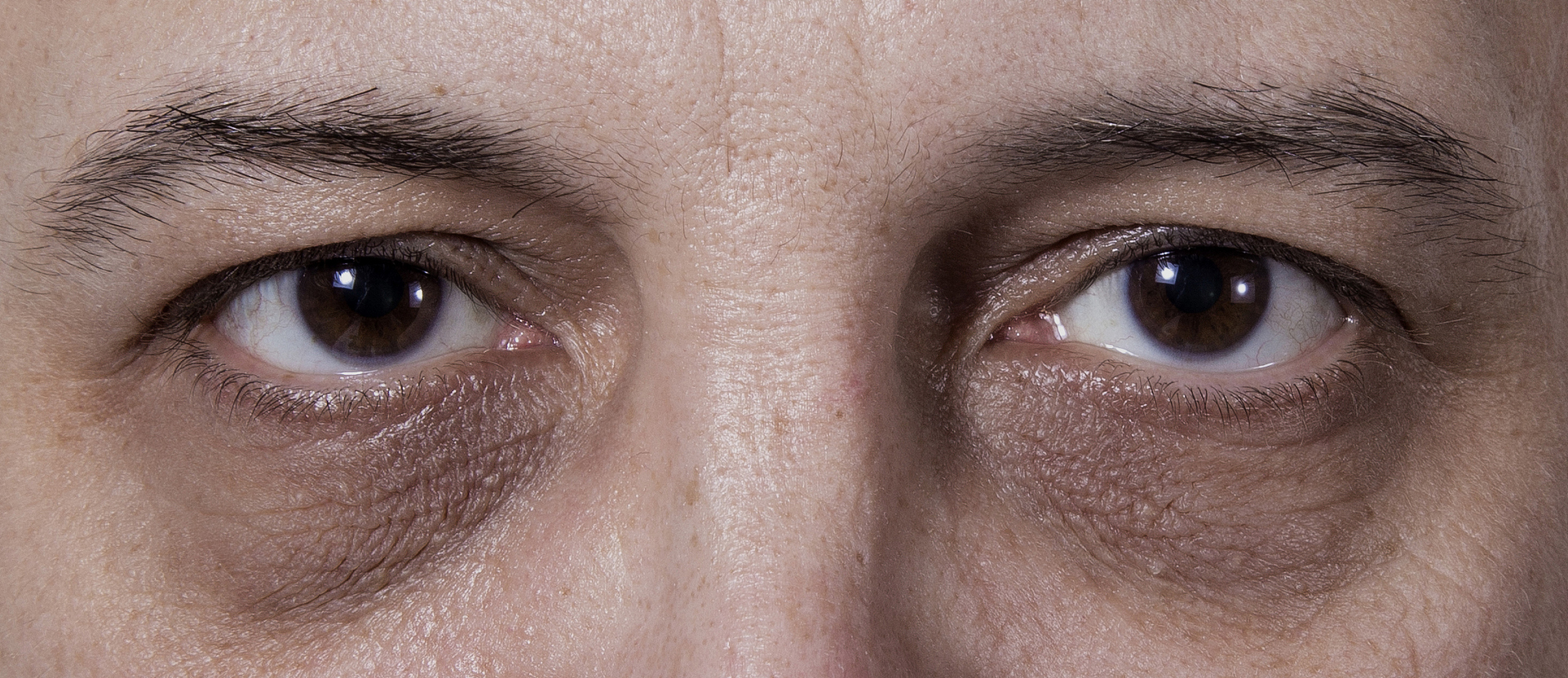 肝不好的人三黑两臭什么意思 1,皮肤黝黑:皮肤暗沉,发黑时,要汪意是否