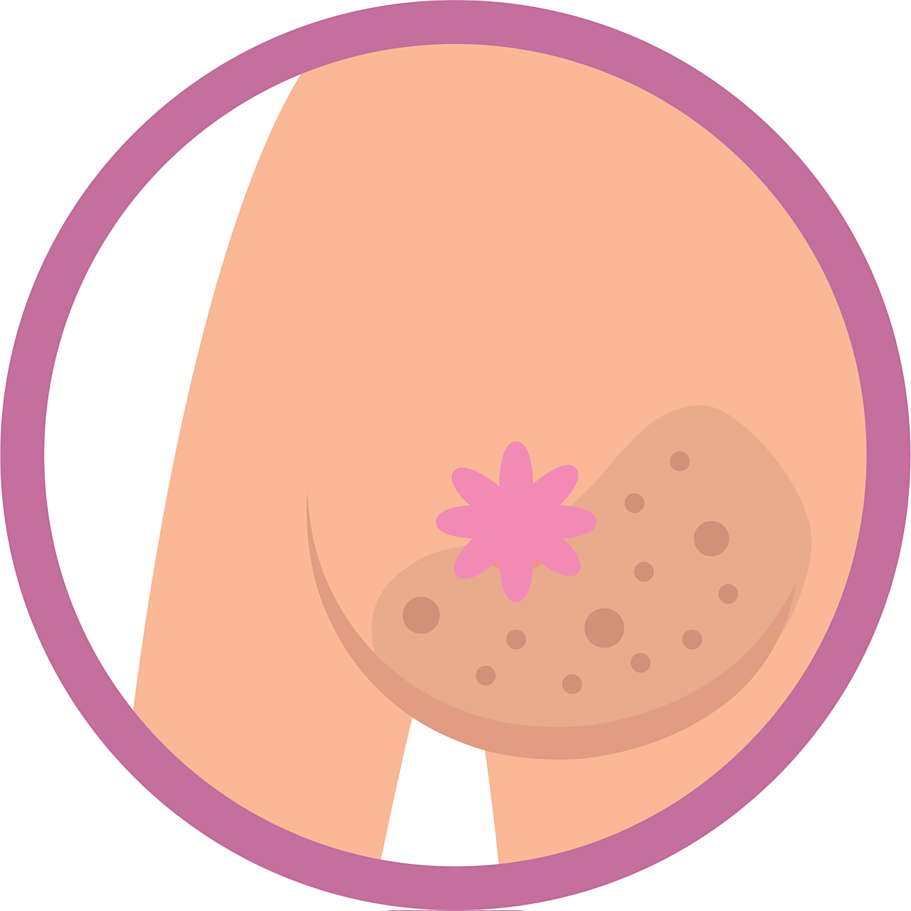 乳头旁边长的小疙瘩可能是以下几种原因导致的:     蒙氏结节,这