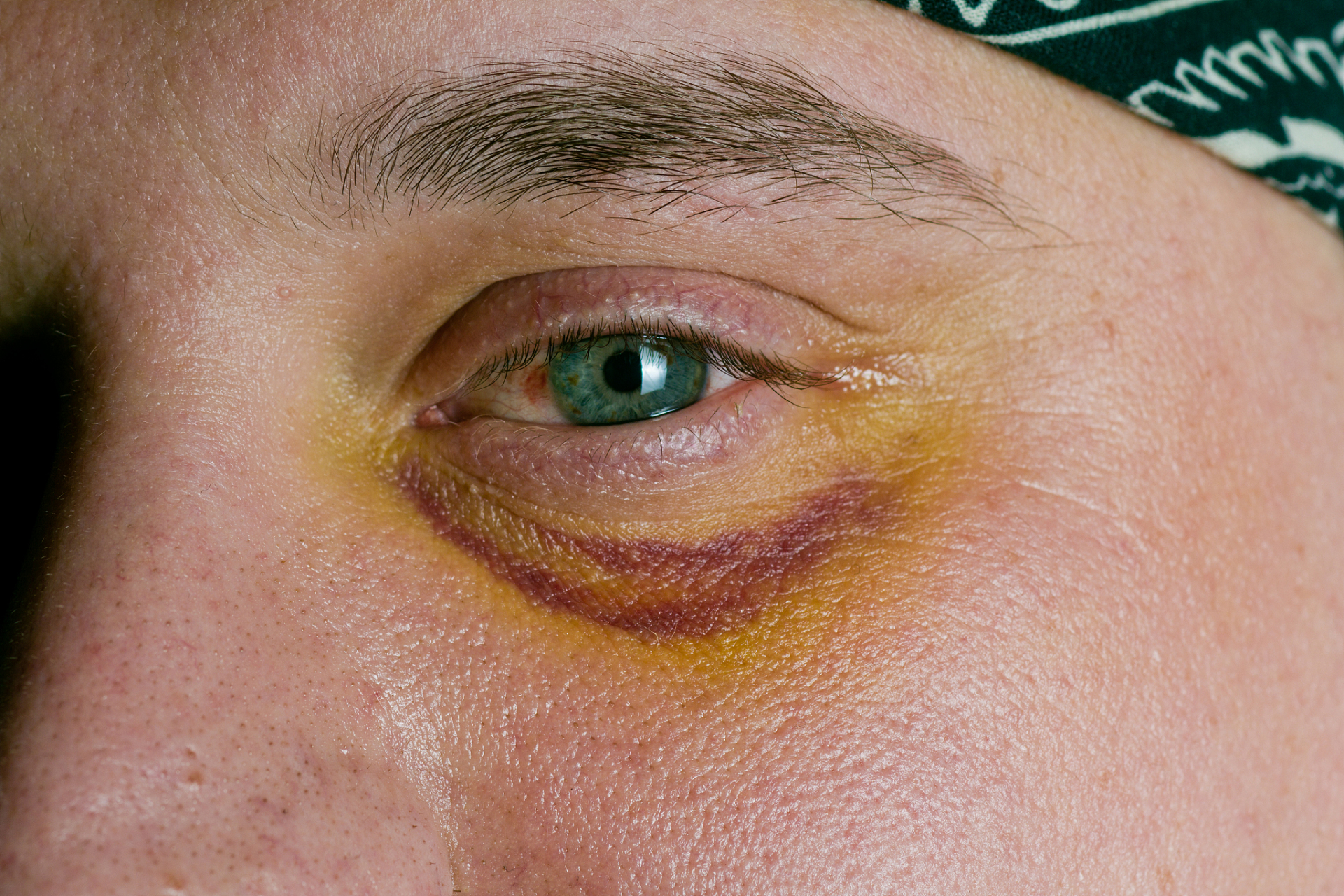 睡眠不足:睡眠不足是导致眼皮浮肿的主要原因之一.