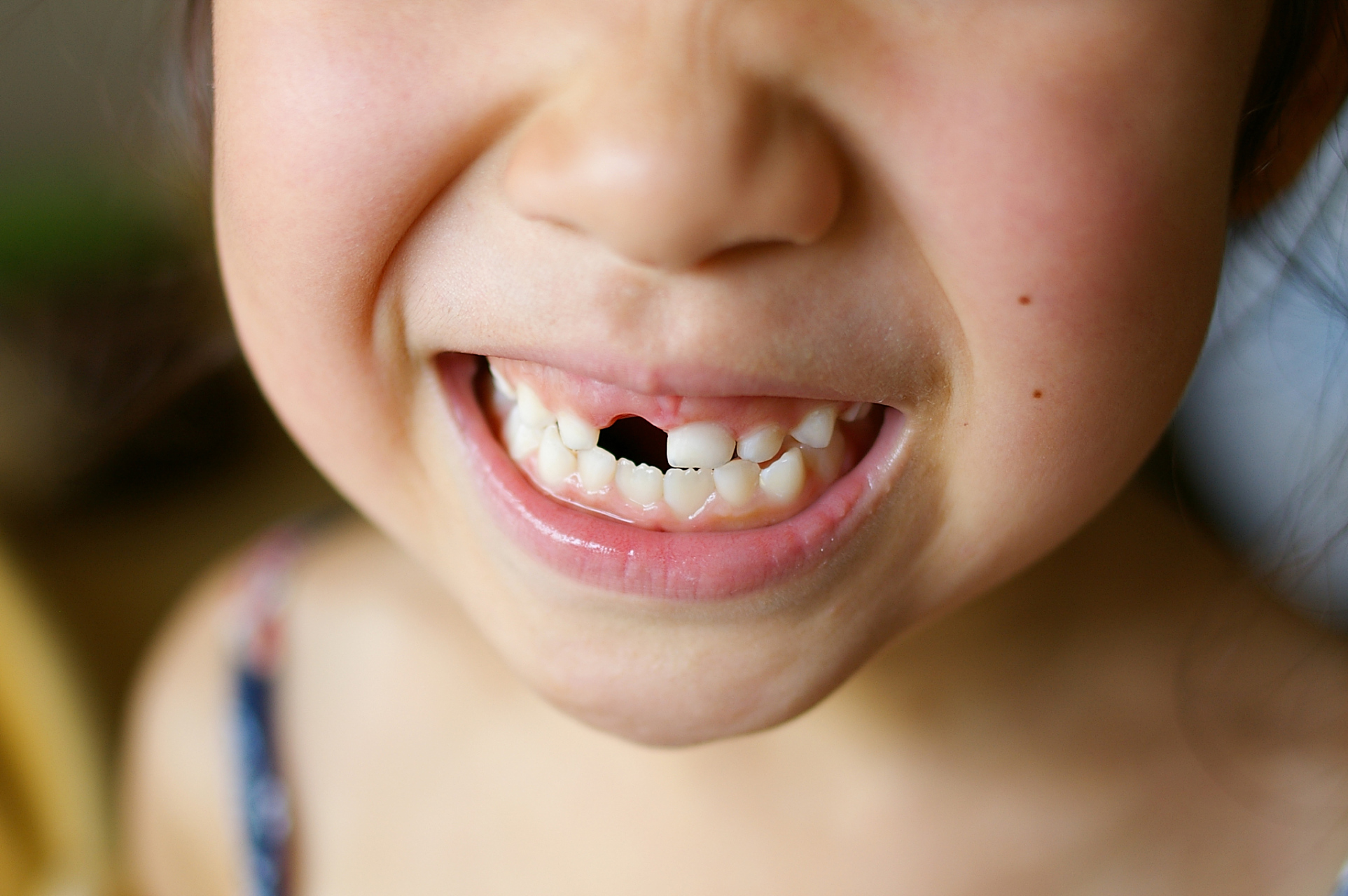 通常情况下,6～7岁时下颌的乳中切牙开始摇动,脱落