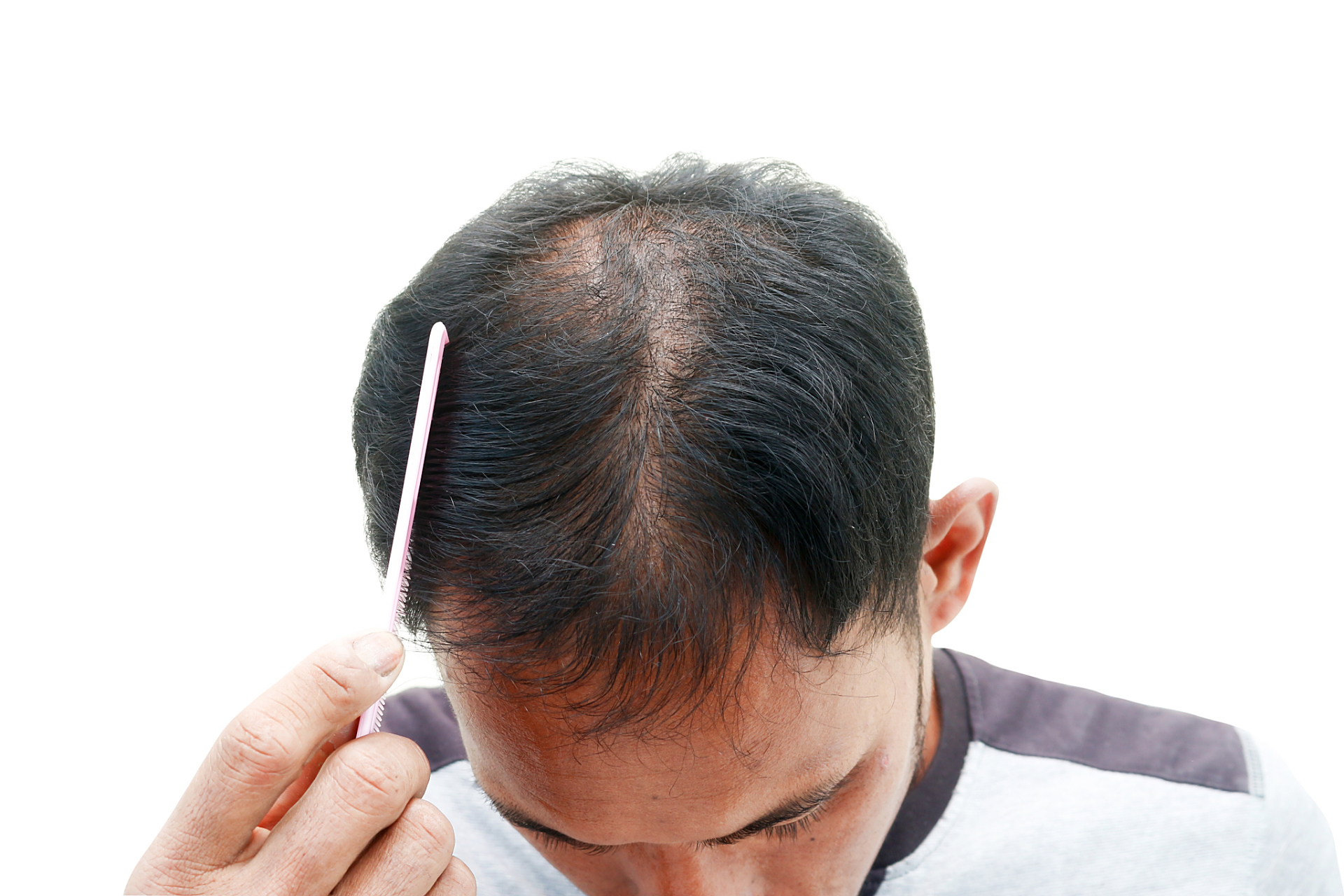 病理性脱发该如何防治?常用的方法有哪些?  1.