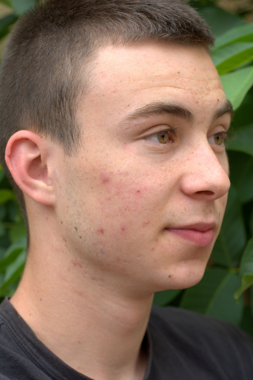 男生人中长痘痘什么原因 #红蓝光祛痘#  痘痘是一种常见的皮肤问题