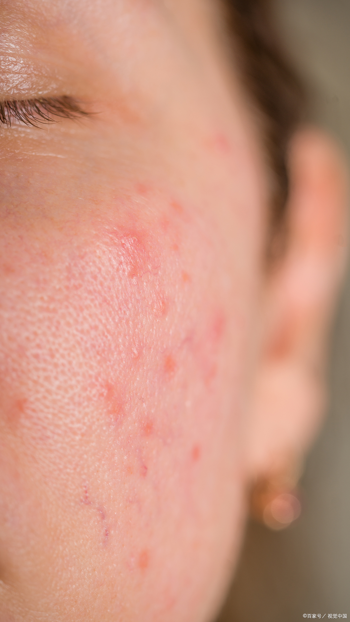 如果怀疑过敏,建议就医进行专业评估,可能包括: 过敏原检测:皮肤点刺