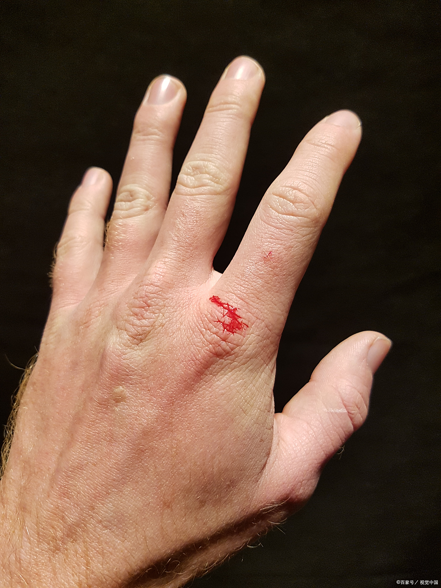 不是所有的伤口都需要跑医院