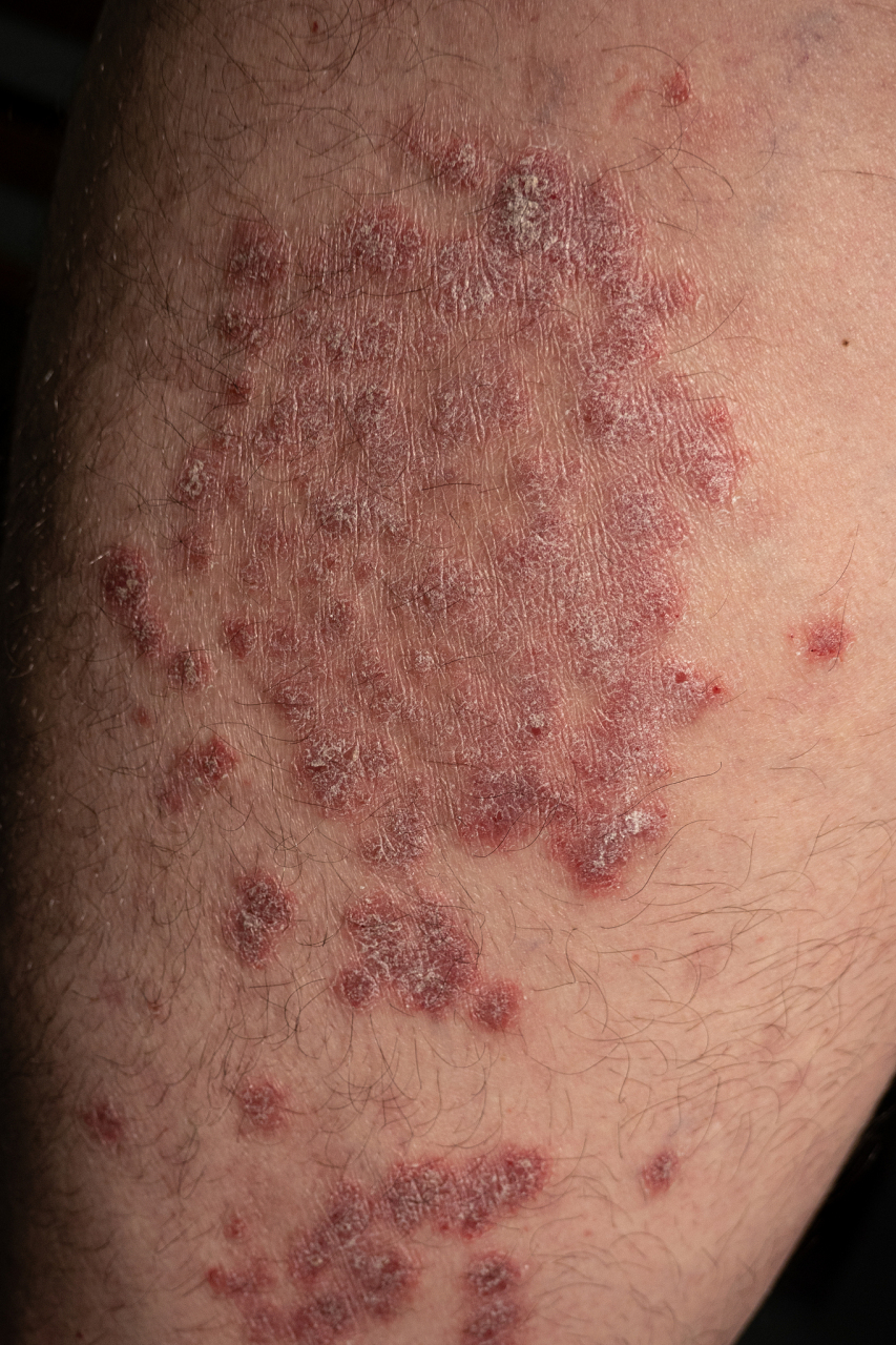 07皮肤科是海绵状血管瘤患者可以考虑的第一个科