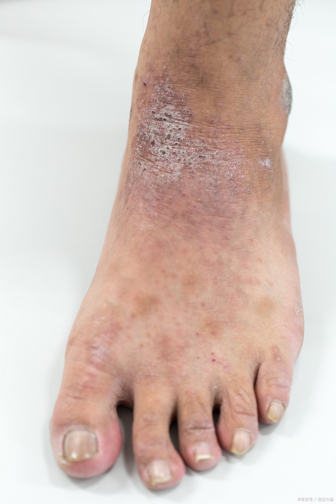 如何治疗  脚背上的癣虽然不严重但容易反复,秋天干燥更容易加重症状