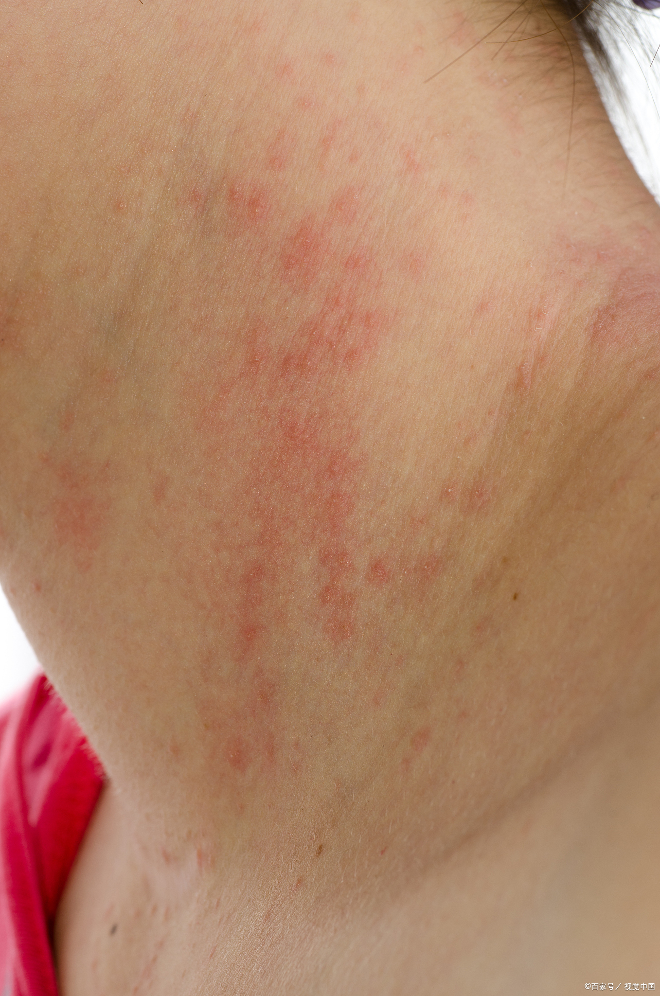 胳膊一晒太阳就起红点很痒怎么回事,怎么办?医生有话说!