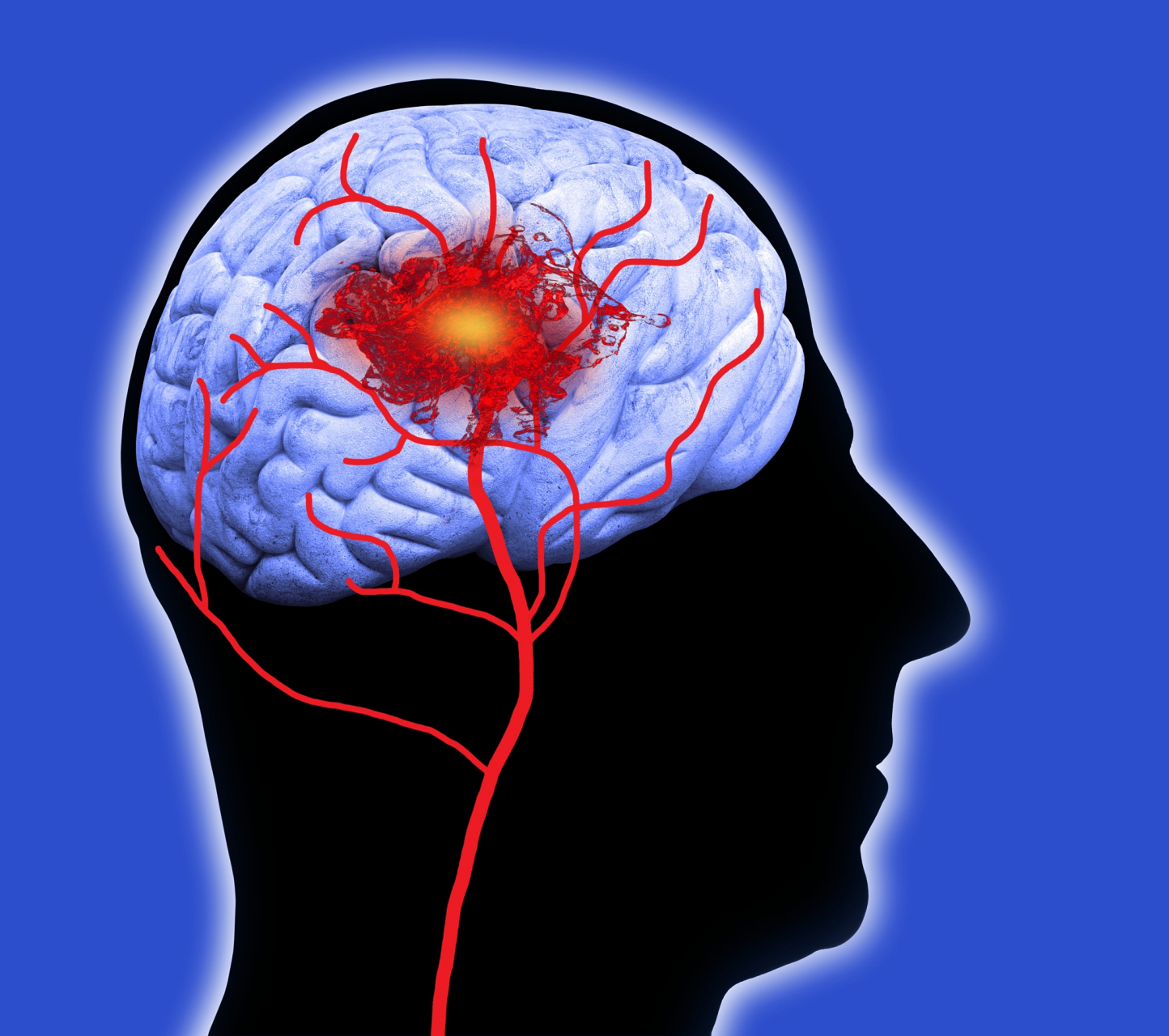 脑出血后癫痫病能治好吗?