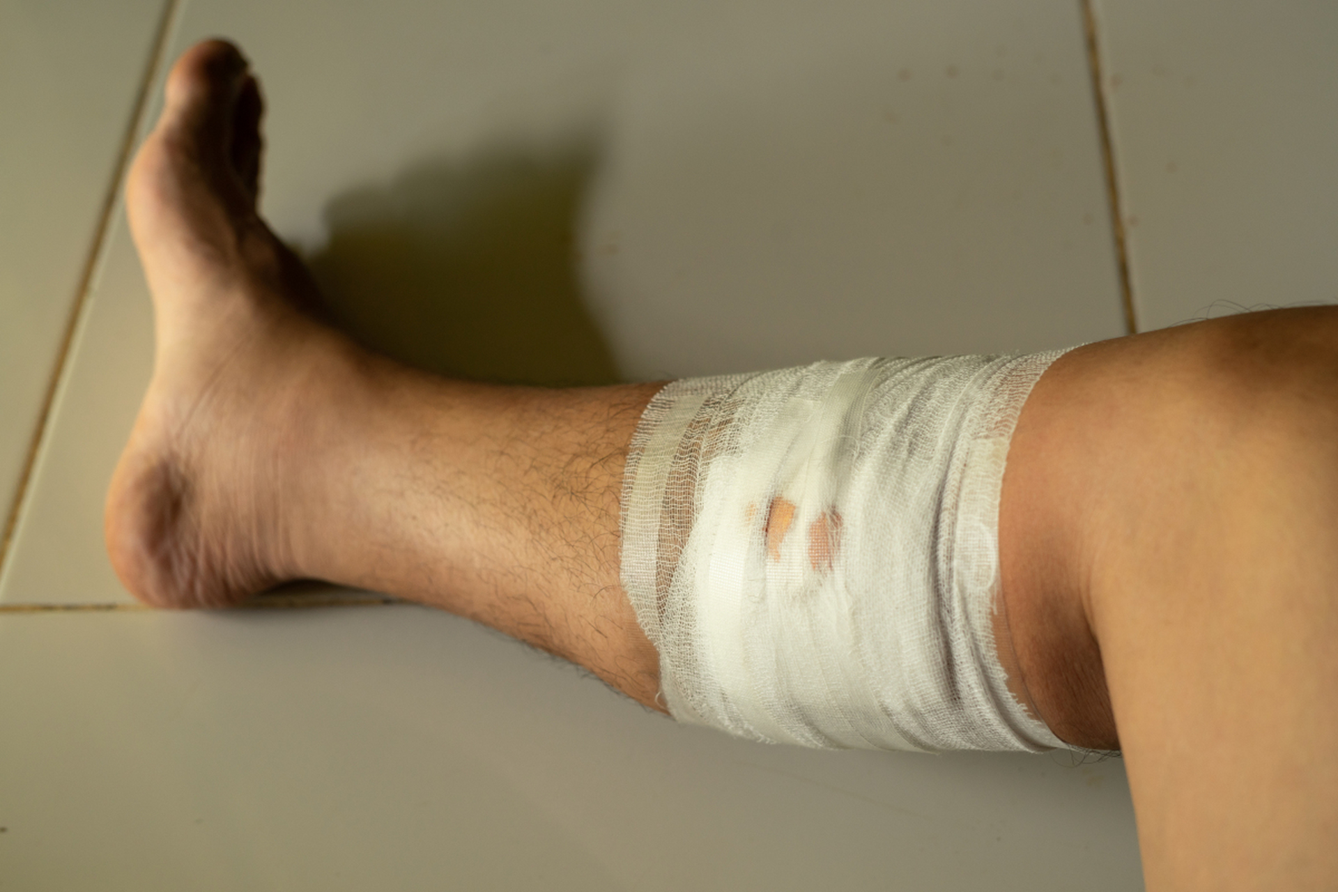 朋友是一名小学数学老师,他说去年春季学期一个周末,他的小腿不慎受伤