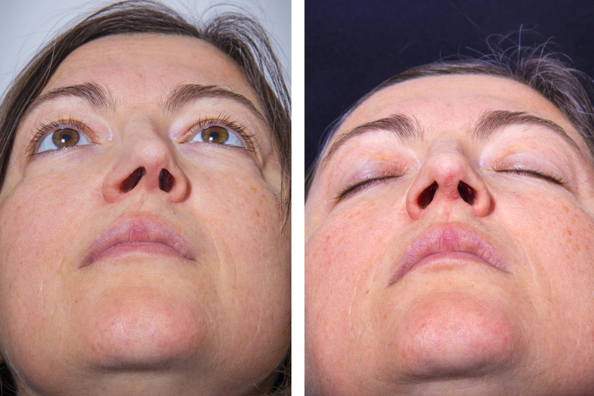 鼻翼高低不一/鼻孔大小不有必要调整吗?