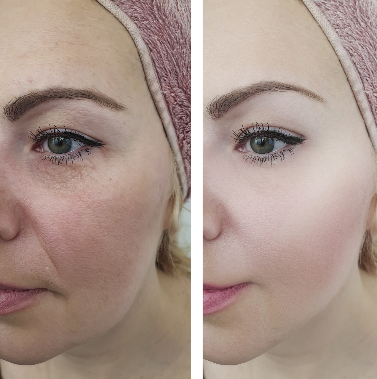 要促进脸部黑色素的代谢,需要注意紫外线是导致黑色素沉积,使用广谱