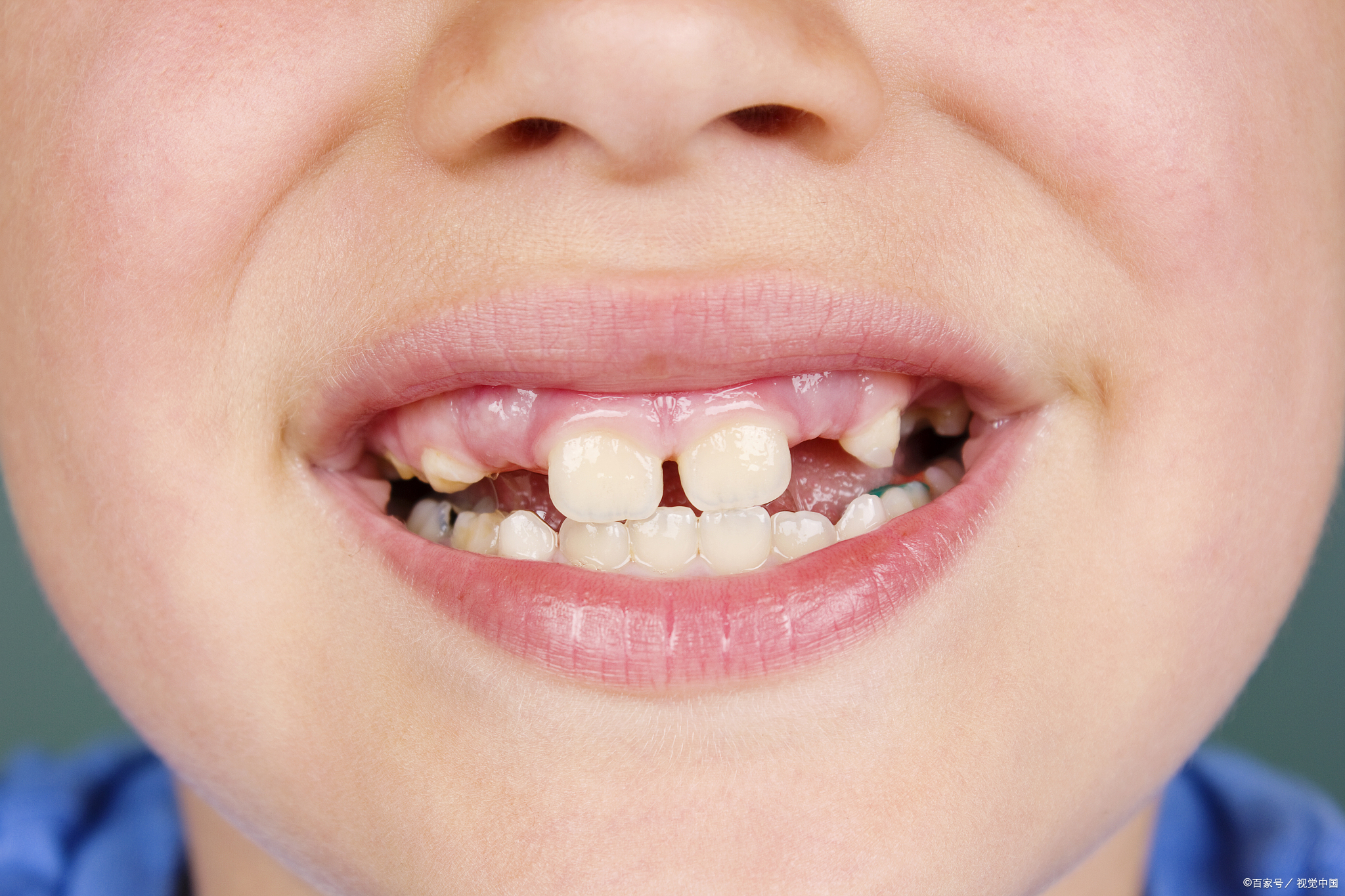 牙齿图片孩子换牙期的图片儿童换牙图片儿童门牙长歪了图片儿童换牙期