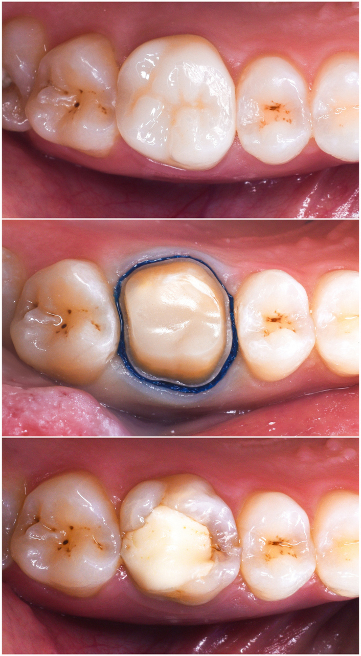 牙列缺损是指部分牙齿缺失导致的恒牙牙列不完整,在中老年人群中属于