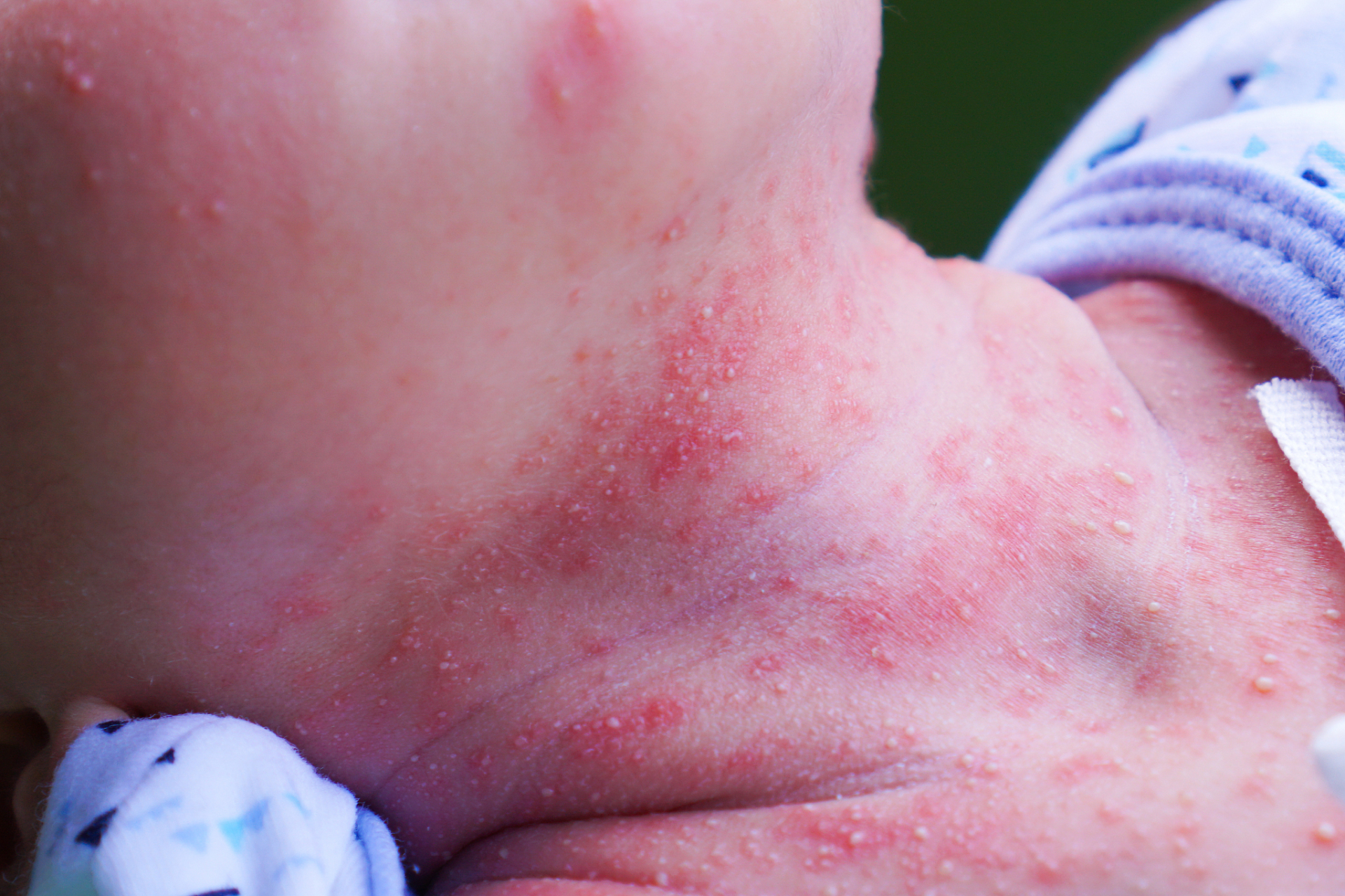 宝宝刚出生,身上却出了一身红疹,是不是因为太热了才会这样呢?