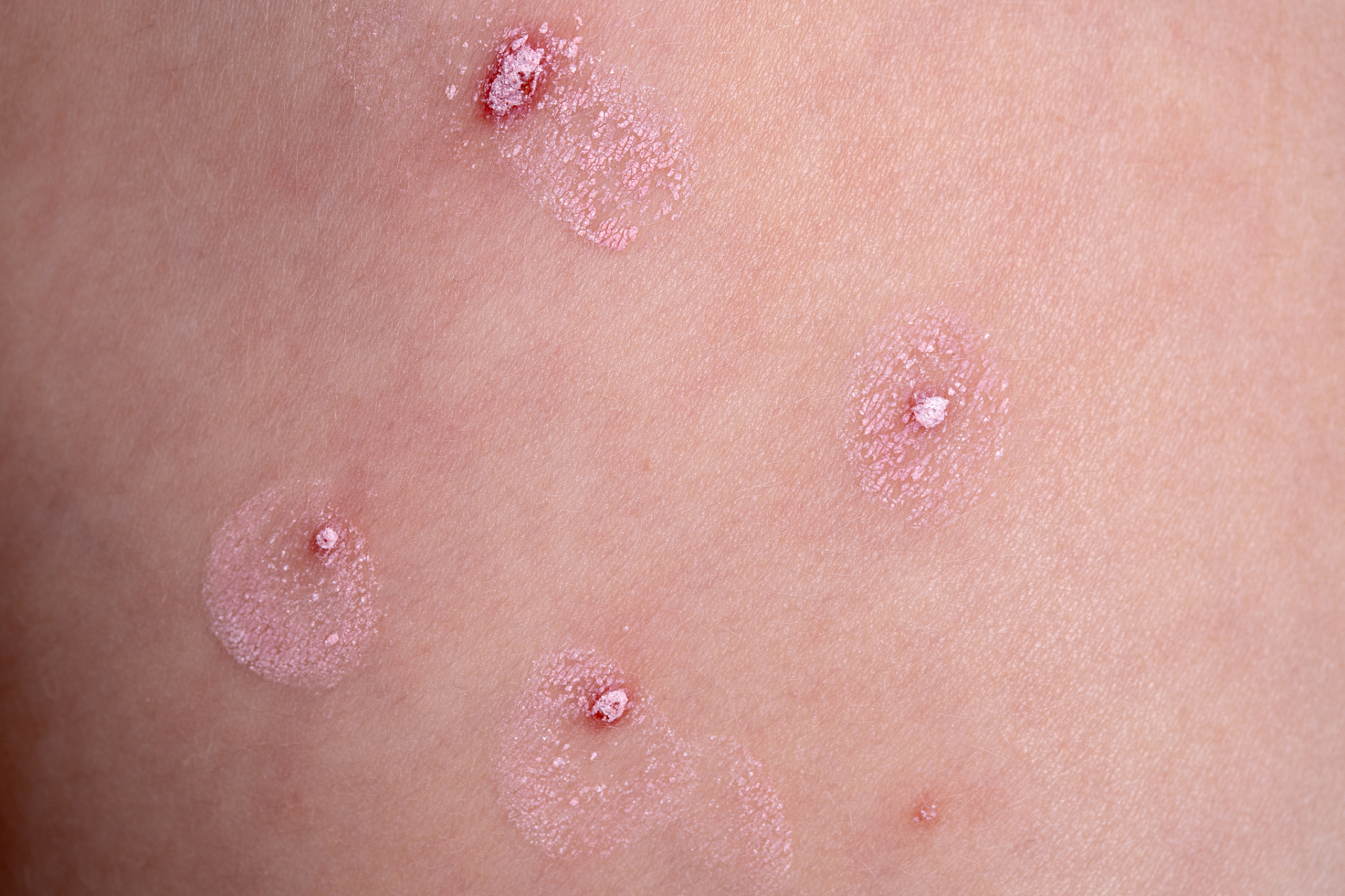 水疱疹一般指的是带状疱疹,是一种急性病毒感染性皮肤病,一般是感染