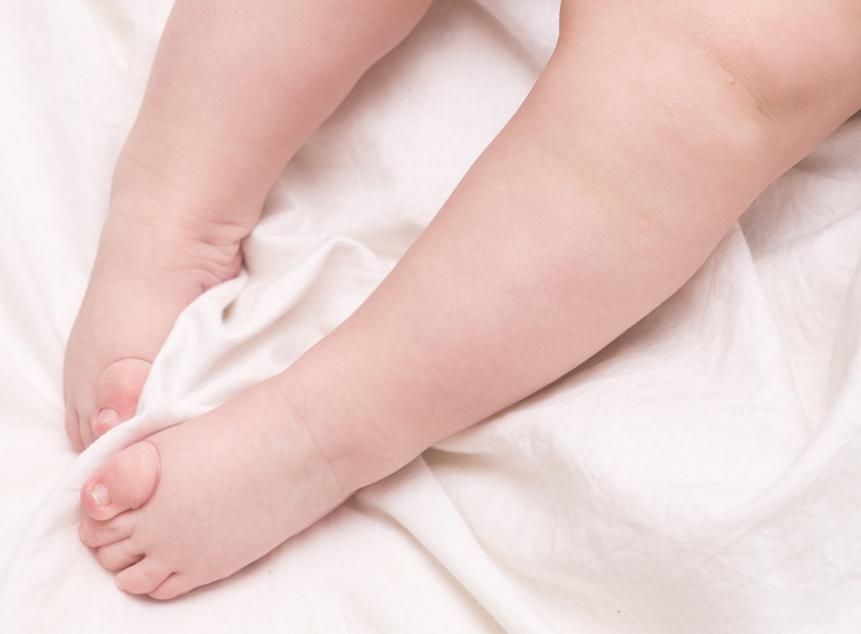 婴儿膝盖有凹陷是什么原因?