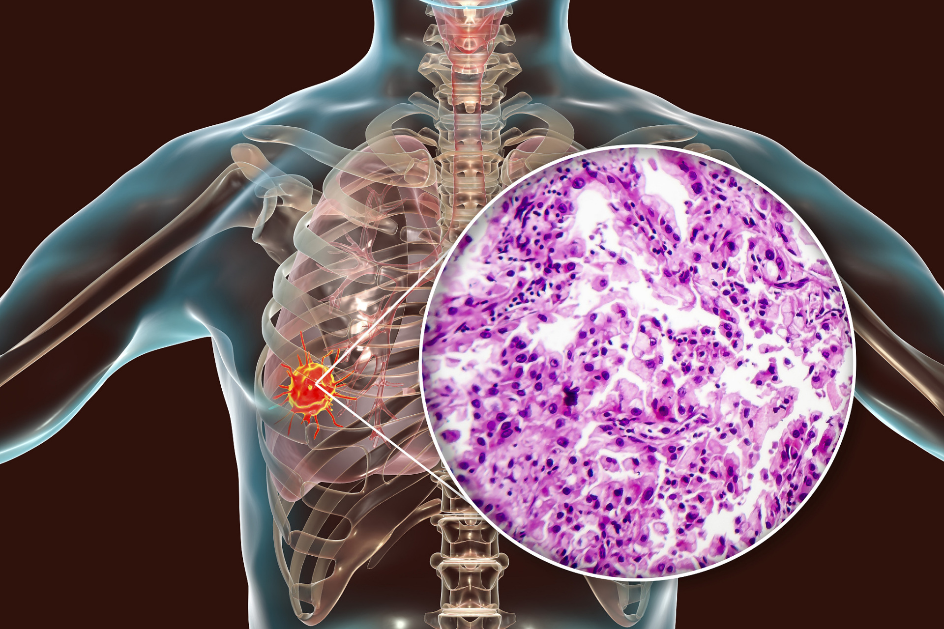 恶性小细胞肺癌为何更推荐放疗?