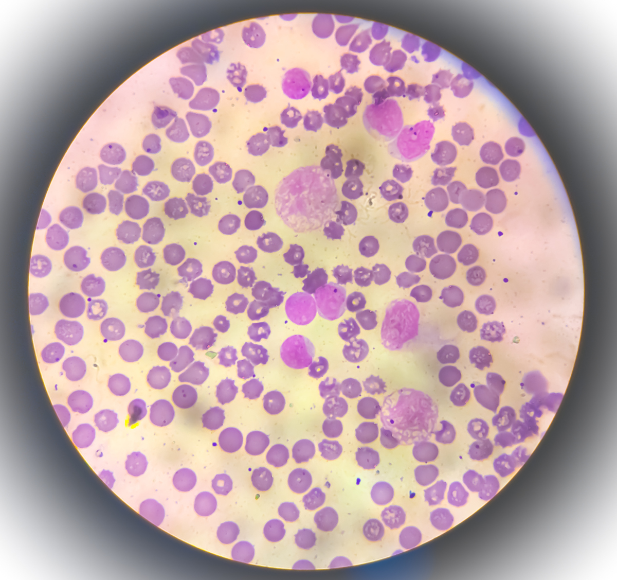 白血病,听起来就让人心生恐惧的疾病,究竟能活多久?