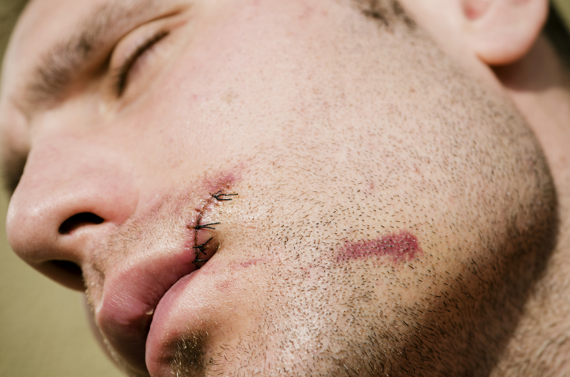 脸擦伤怎样防止留疤  如果脸部擦伤不严重,以下是一些措施可以帮助