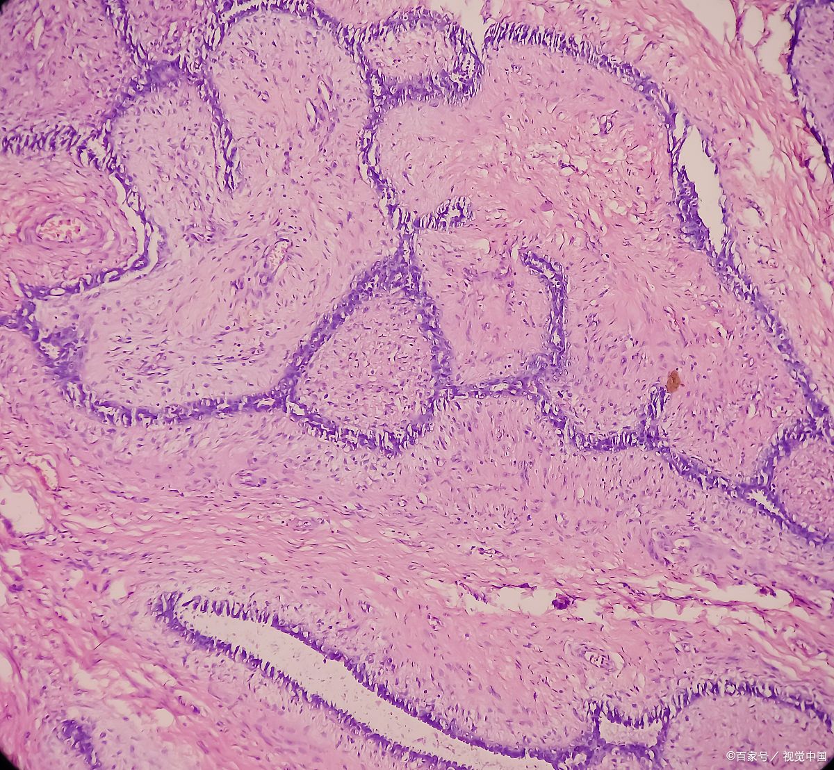 关键科普解析 乳腺良性肿瘤是一种常见的乳腺组织非癌性肿块,由正常