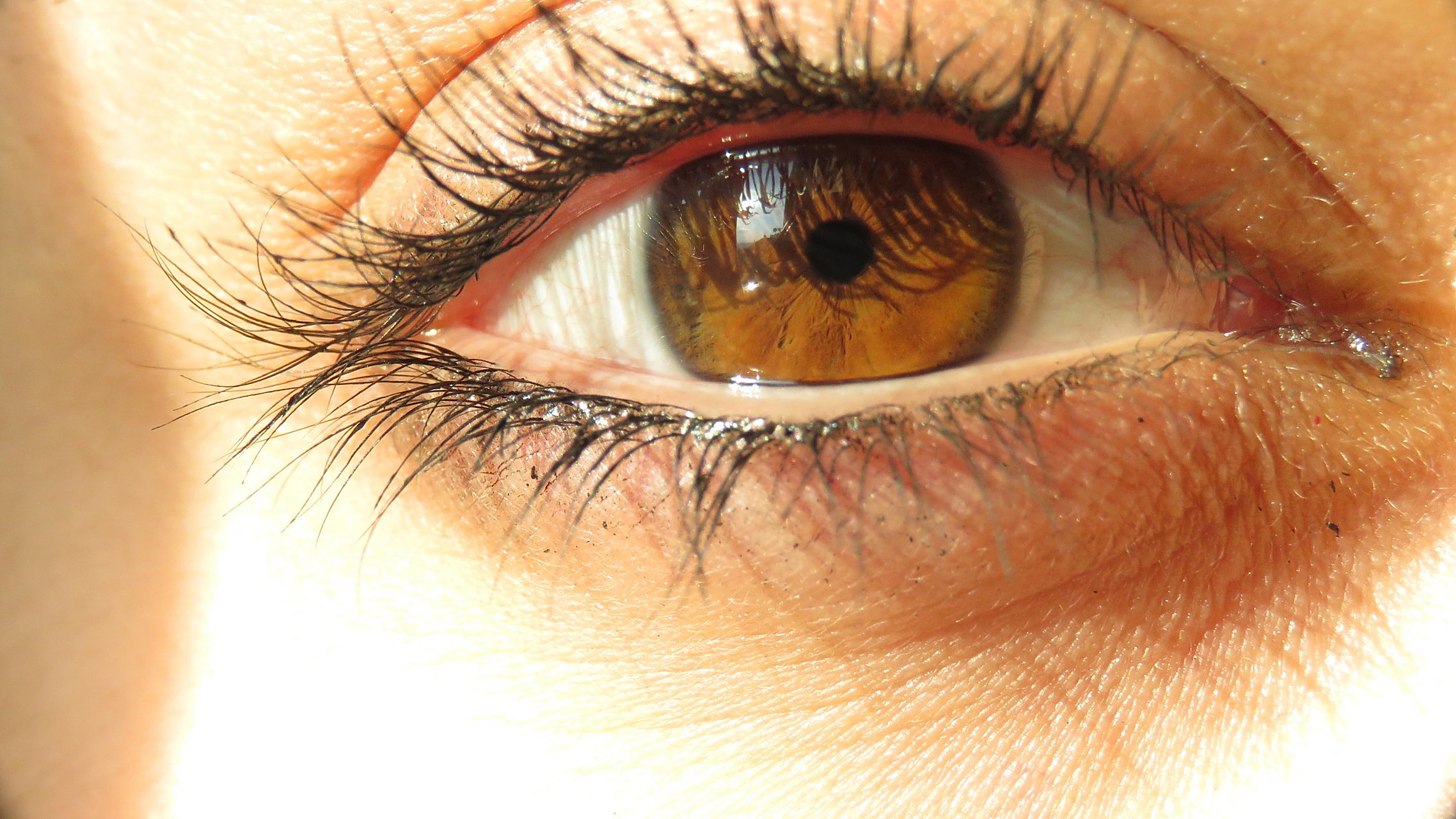 从眼睛可以看出胆固醇是否高 1,视力变得很差 胆固醇