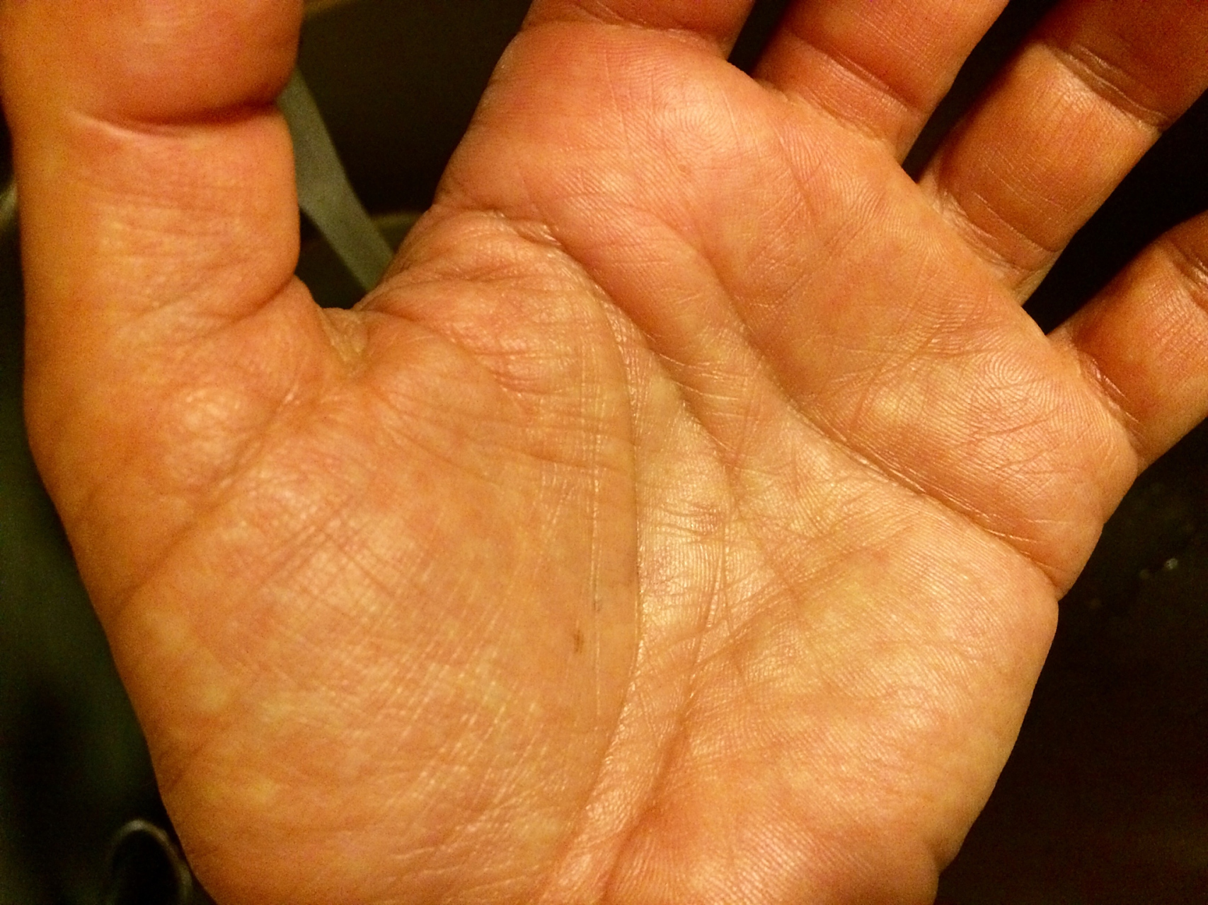 手心发黄的原因有哪些?