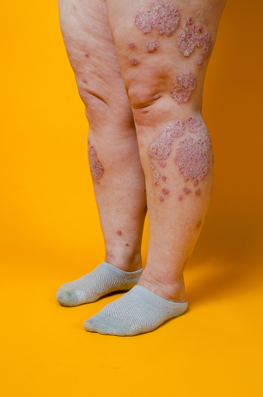 荨麻疹种类及症状图片图片