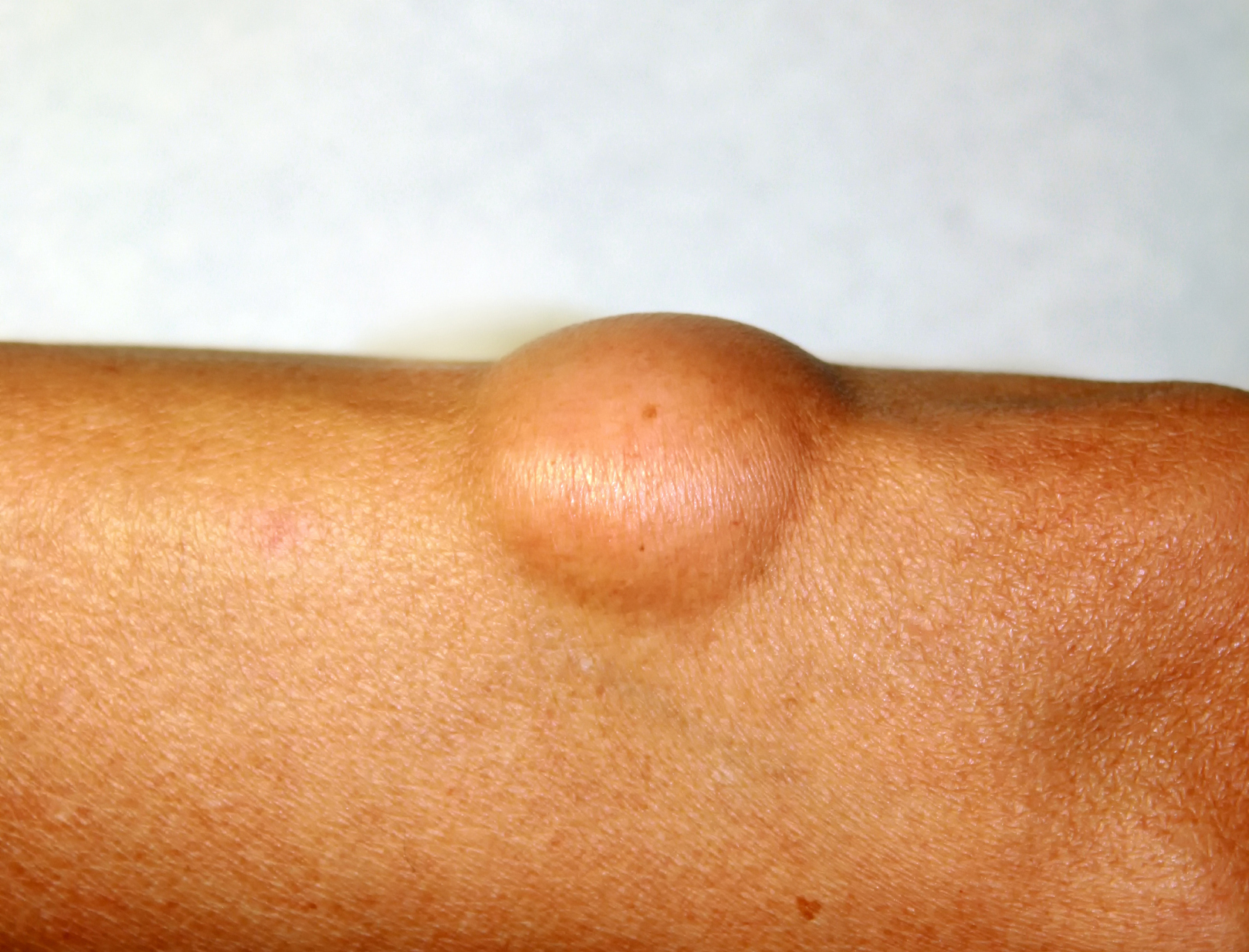 【骨化纤维瘤,隐藏在身体中的隐形炸弹:一种不可忽视的疾病】  骨化