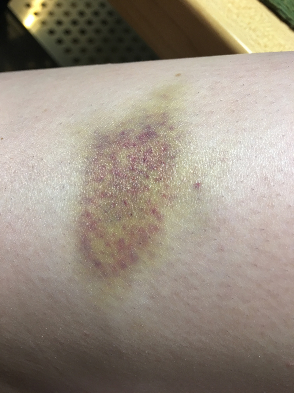 虽然淤青的完全消除需要时间,但以下方法可以帮助加速