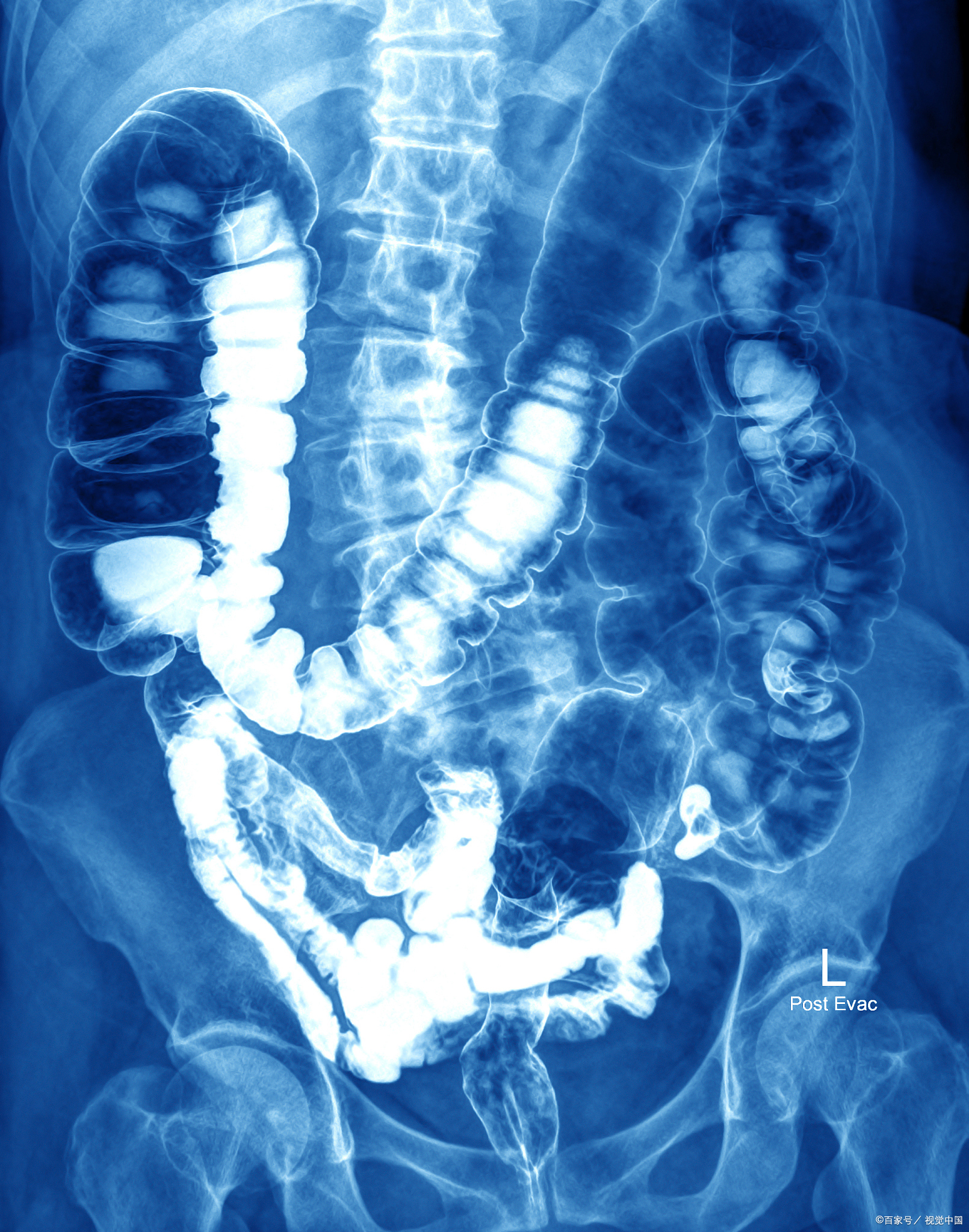 半个月前开始左侧腰痛不适,做了一个腹部增强ct
