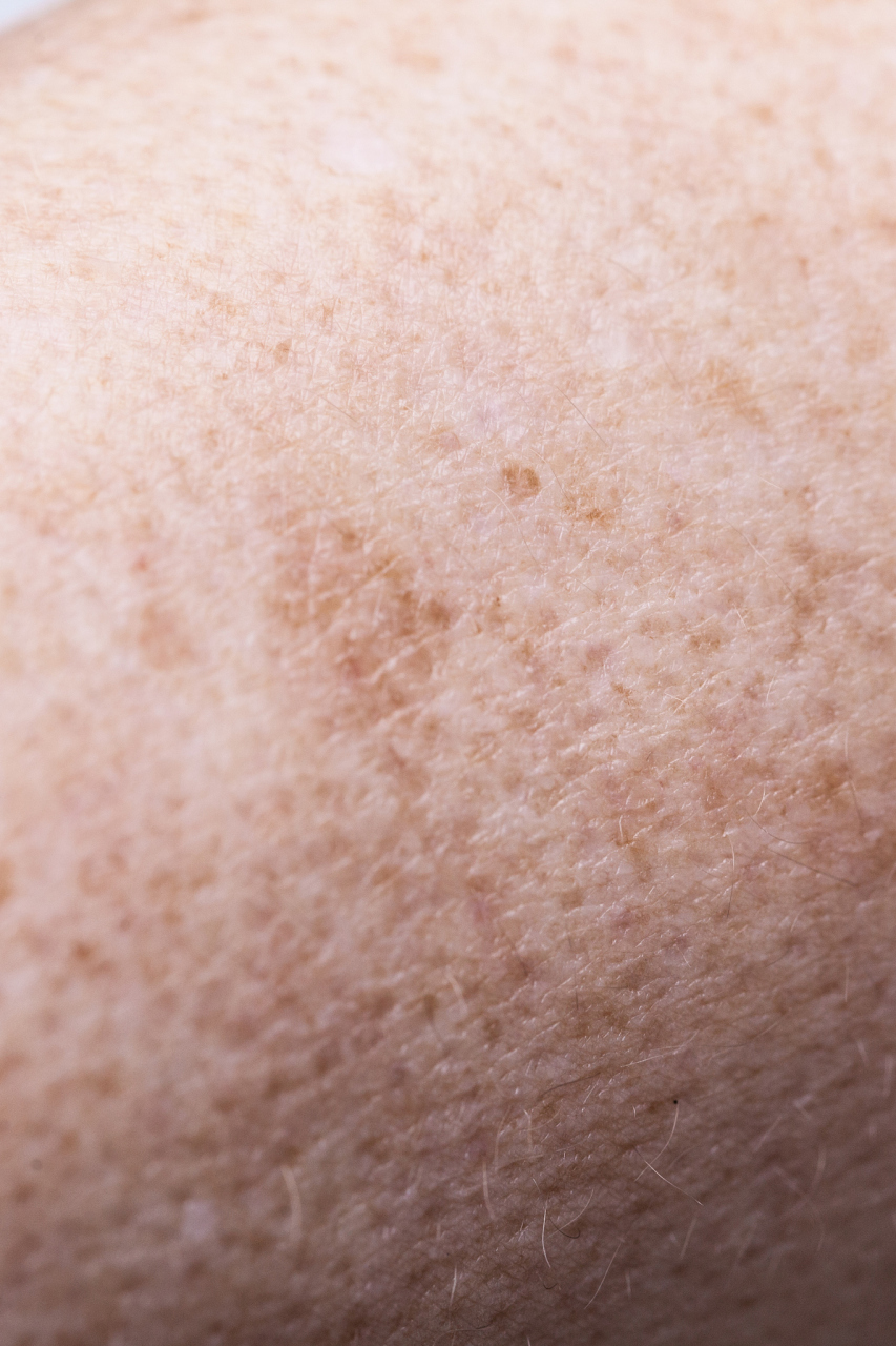 男性生殖器官长白色小颗粒,有可能是毛囊炎,阴茎珍珠状丘疹,皮脂腺