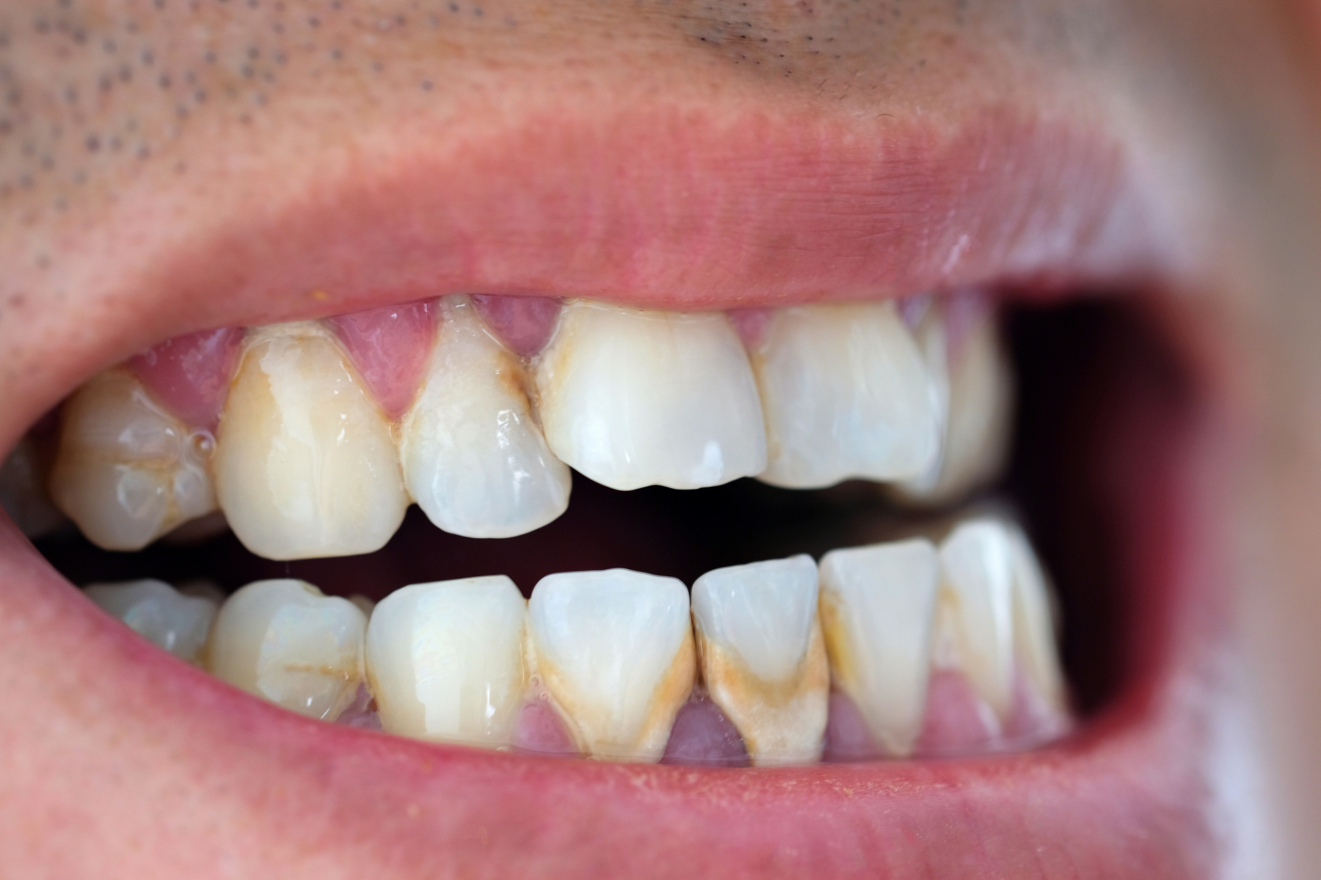 牙齿发黑的原因可能是由于外源性因素或内源性因素引起的.