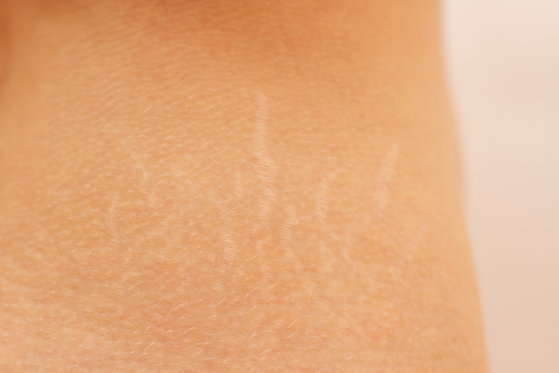 更多 生完孩子后肚子上长了很多妊娠纹,老公还嫌弃我,我想知道有没有