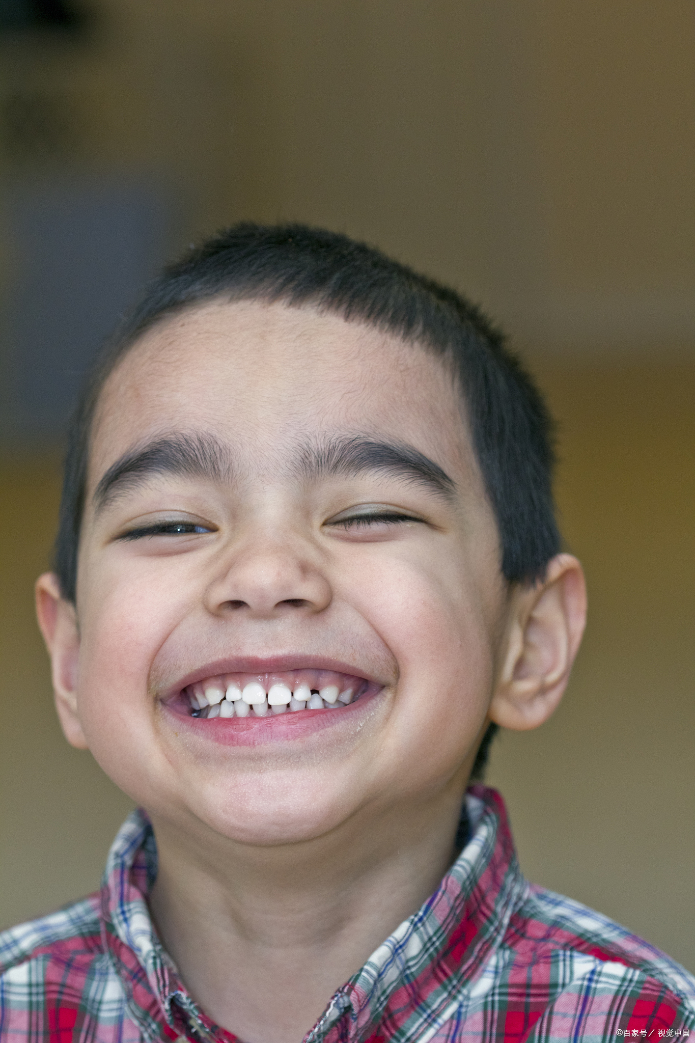 【今日科普】| 龅牙的形成原因 龅牙的形成有可能是因为遗传,也有可能