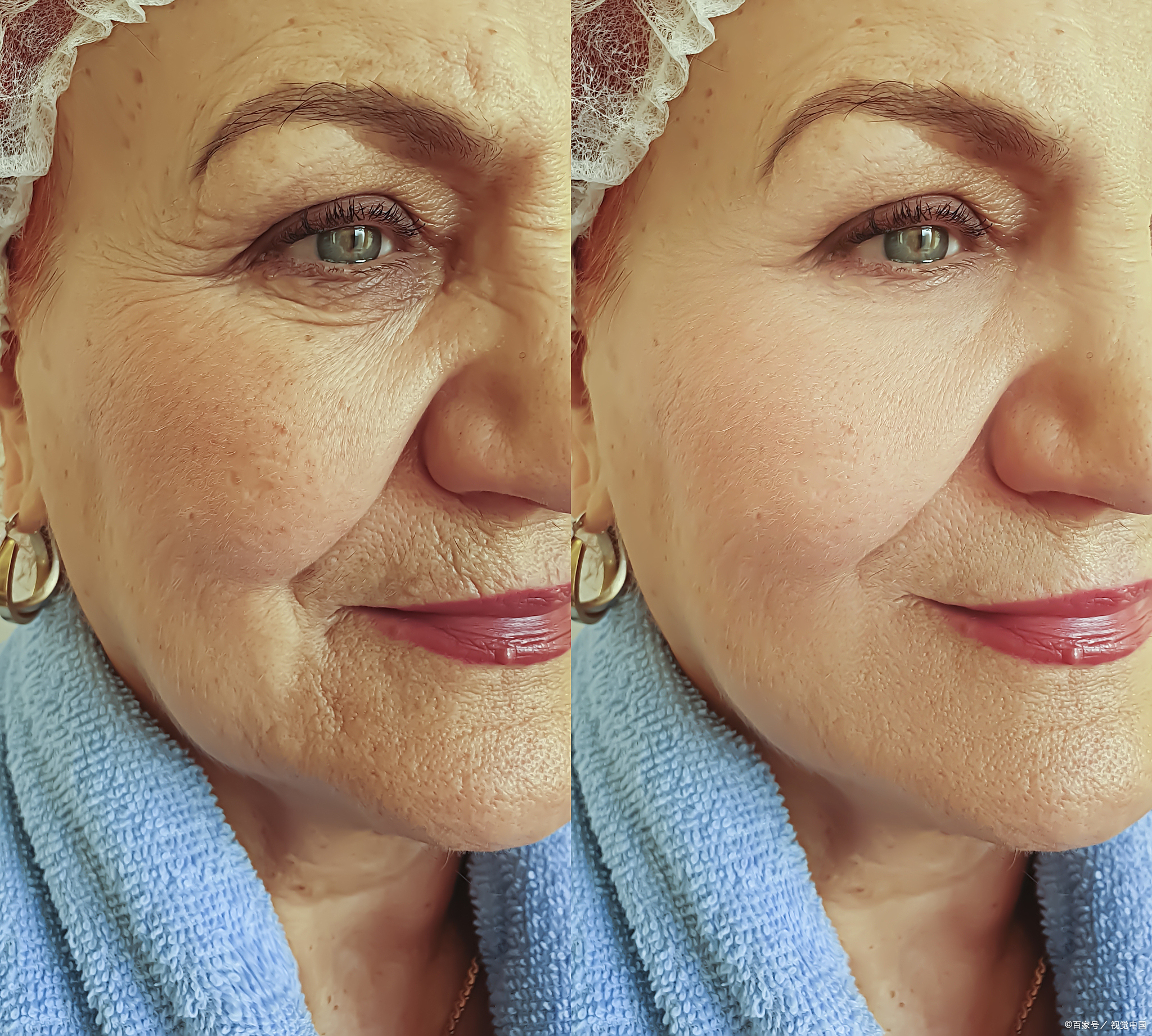 胶原蛋白可以除皱吗?怎样有效补充胶原蛋白?