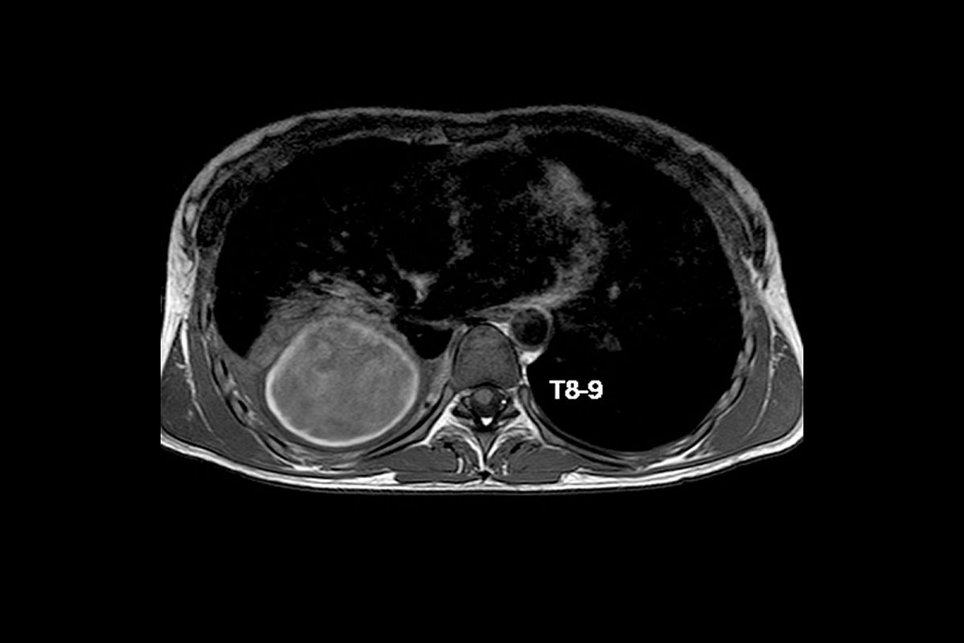 【胸腺瘤病理的分型】 胸腺瘤作为一种常见的前纵隔原发肿瘤,其病理分