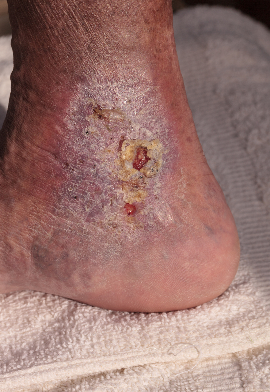 一年前,她的左脚开始出现隐痛,随着时间的推移,这种疼痛变得越来越