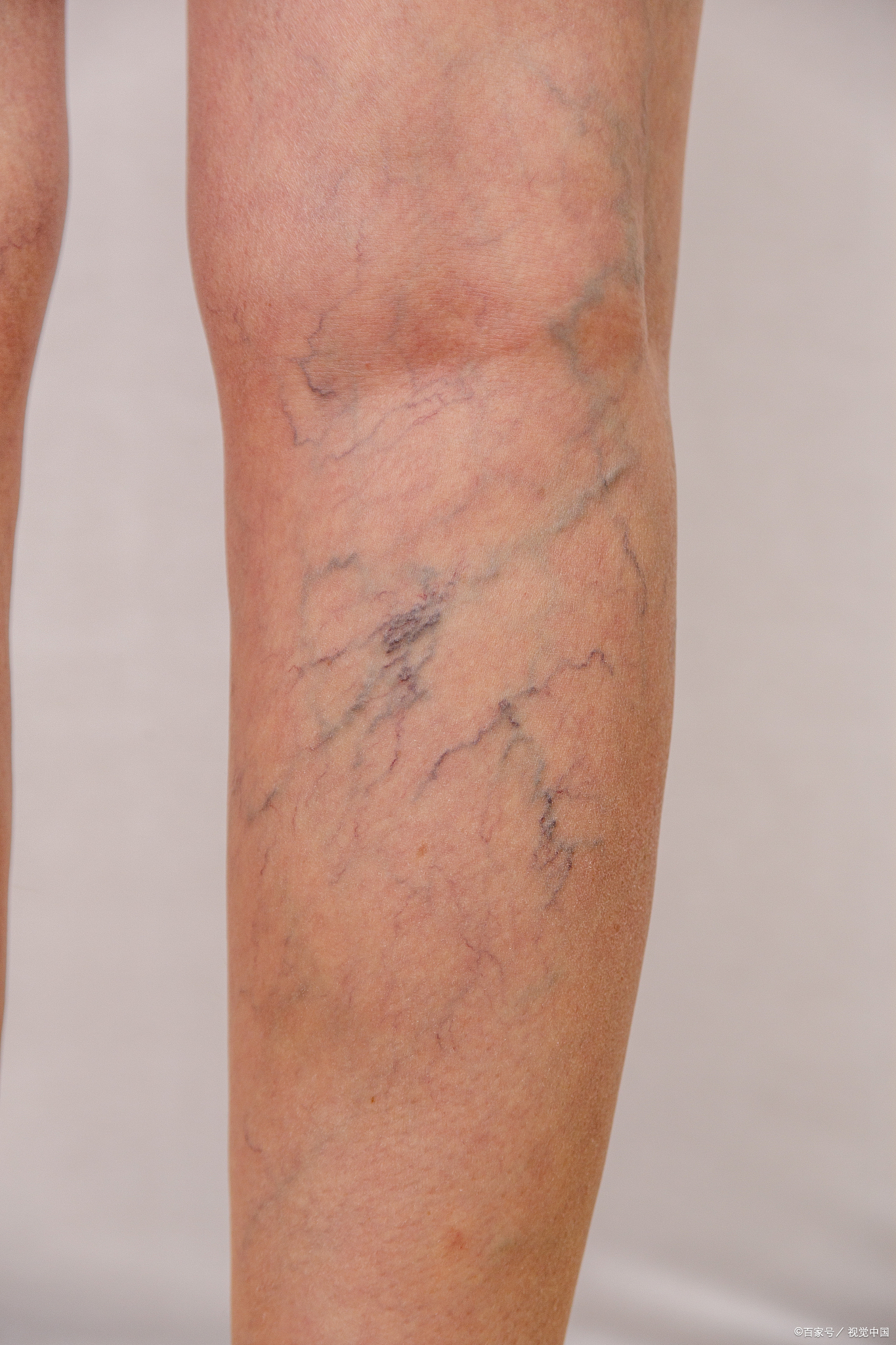 打破静脉曲张困扰,中医调理助你重拾健康双腿