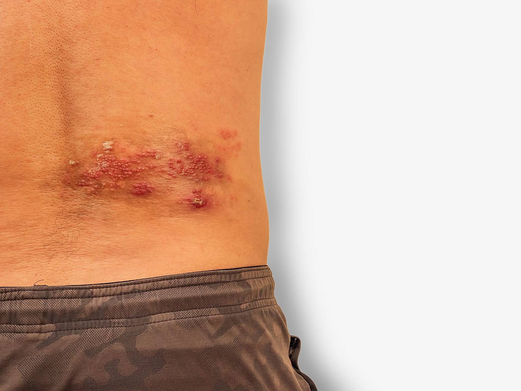 带状疱疹#   首先,带状疱疹是什么?