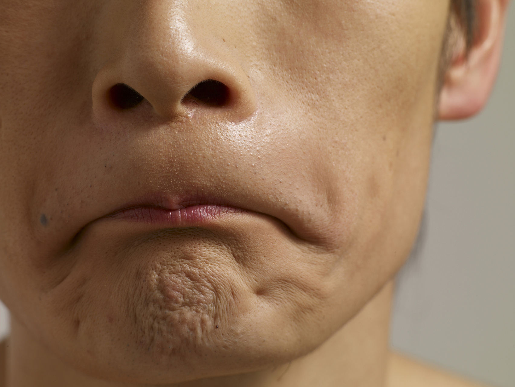 酒糟鼻能治愈吗#   酒糟鼻,酒糟鼻,鼻糟,心更糟糕.