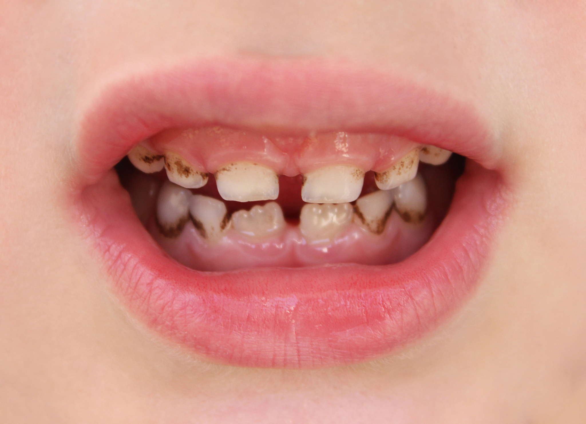 儿童牙齿蛀牙的主要原因是什么?