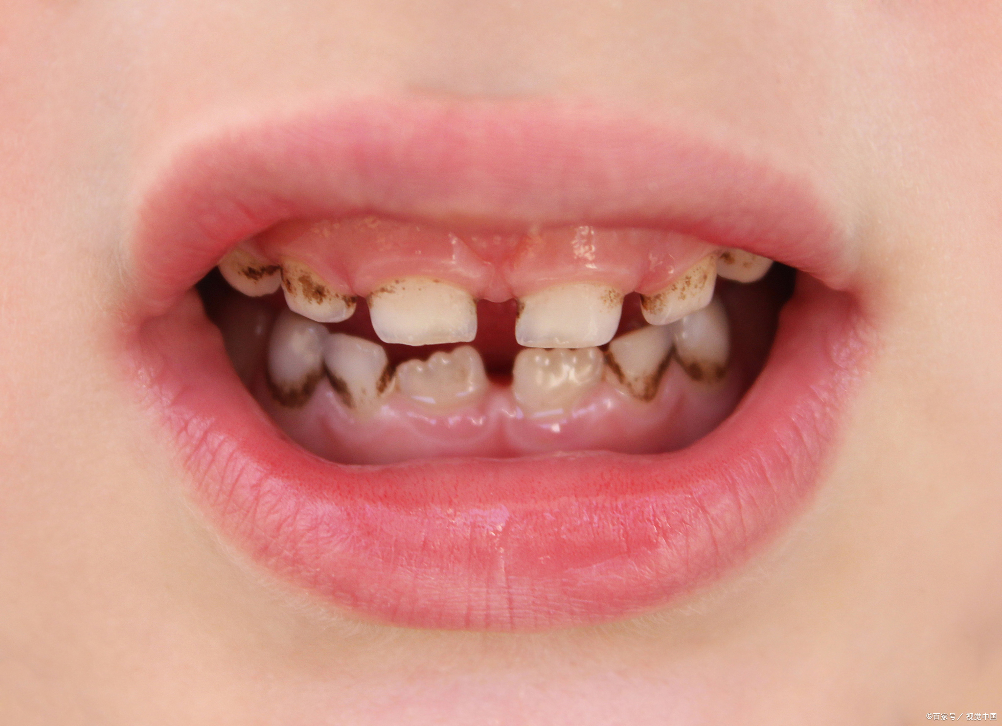 宝宝牙齿发黑,医生告诉你背后的秘密!