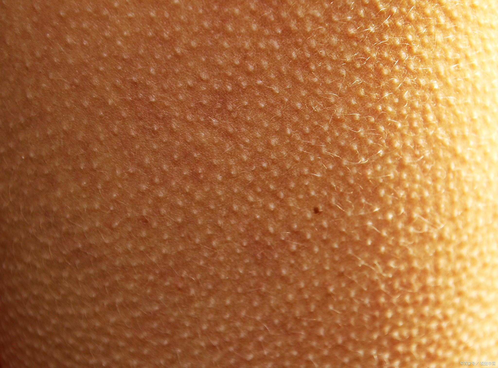 苏州肤康皮肤病医院:手臂有鸡皮肤疙瘩粗糙该如何变光滑?